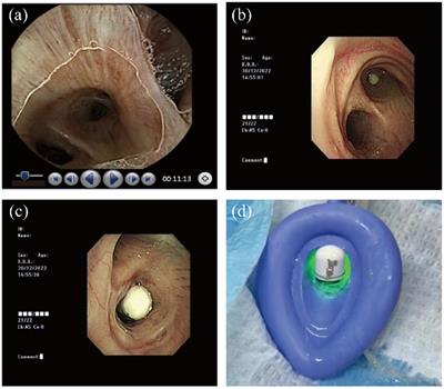 Capsule endoscopy aspiration and respiratory physician’s treatment insights: a case report and literature review